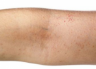 皮肤瘙痒应如何改善 皮肤瘙痒的治疗方法