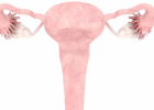 卵巢囊肿应该怎么办 卵巢囊肿的症状