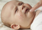 婴儿湿疹应该怎样护理 母乳喂养能预防婴儿湿疹吗