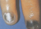 灰指甲是皮肤病吗 治疗灰指甲的偏方