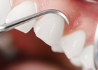 孕前牙齿需要检查吗 孕前牙齿检查的项目