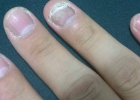 治疗灰指甲有哪些偏方