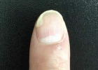治疗灰指甲的偏方有哪些