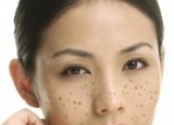 脸上长斑的原因 女人警惕妇科病