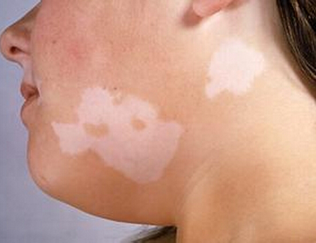 皮肤疾病 白斑疾病如何治疗？