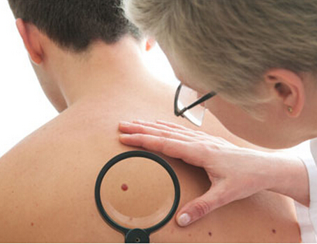 皮肤癌 哪三类皮肤病小心会致癌？