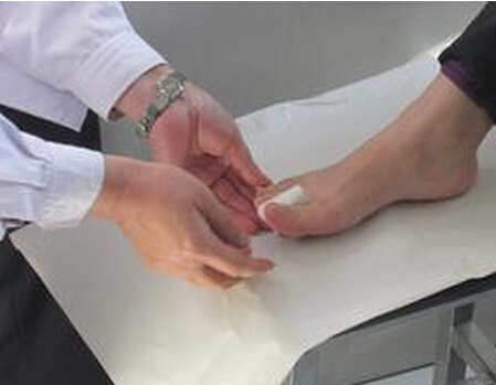 脚指疾病 拇指外翻如何治疗？