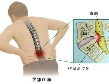 腰肌劳损症状 治疗腰肌劳损方法有哪些？
