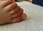 脚指甲疾病 造成指甲脱落原因