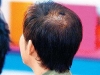 什么原因导致男性脱发