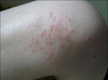 男人在夏季要怎么预防接触性皮炎