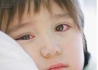 红眼病治疗   夏季患上红眼病怎么办