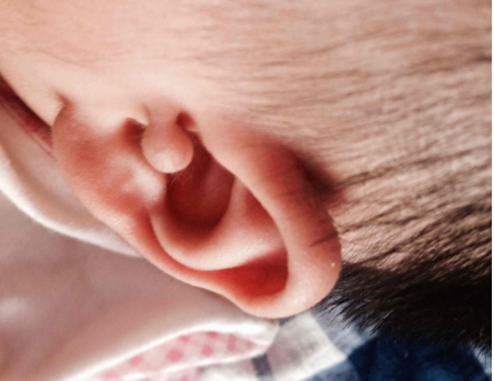 耳垂带硬疙瘩是什么疾病？