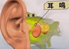 耳鸣怎么办 中医教大家如何治疗耳鸣