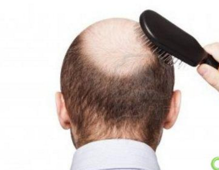 脱发怎么办 男性中年如何预防脱发问题