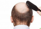 脱发怎么办 男性中年如何预防脱发问题