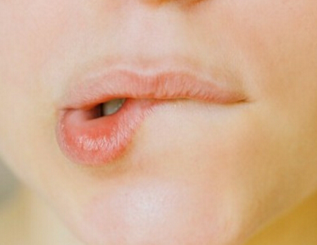 干燥秋季嘴唇起皮严重 如何护唇？