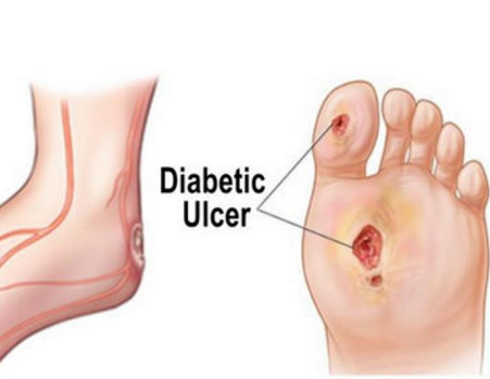 糖尿病足溃疡的预防