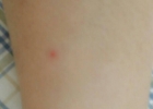 【图】皮肤上有小红点是怎么回事？