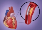 心脏杂音怎么办 心脏杂音分为哪几类？