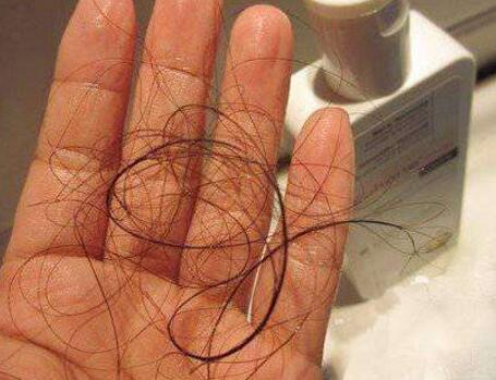 应对每天因洗发掉发的治疗方法