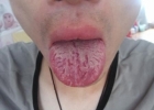 舌头裂口是否能治疗