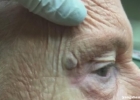 老人眼角长了个怪东西，手术后取出的东西令人吃惊