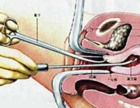 刮宫后月经量少怎么办