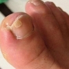 灰指甲症状 灰指甲的传染性
