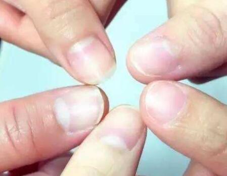 手指甲里没有月牙是疾病？