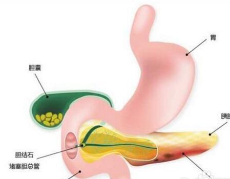 胆结石发病率原因