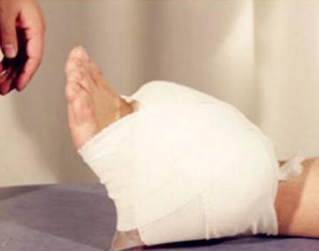 脚踝扭伤治疗方法 脚扭伤处理后怎么办