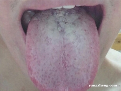 出现这些症状有可能是口腔癌的前兆