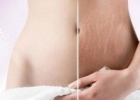 女性毁了皮肤 平坦小腹妊娠纹消除法