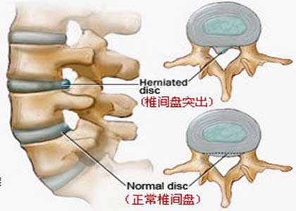 腰椎间盘突出症