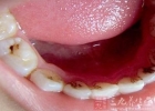 孕妇牙齿痛怎么办 远离四大误区治孕妇牙痛
