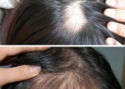 治疗脱发的偏方 八大方法治疗脱发