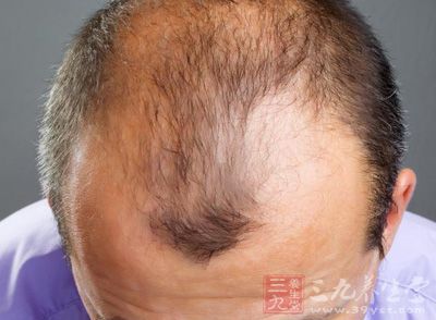 当每天掉的头发超过100根时，就是开始脱发的警告，如果这种现象持续2-3个月以上，就应该尽快到专业机构治疗了