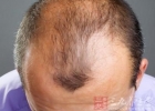 脱发的原因 男性脱发三大因素