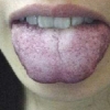 青紫舌头是怎么回事 舌头青紫色是患病了？