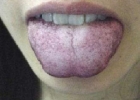青紫舌头是怎么回事 舌头青紫色是患病了？