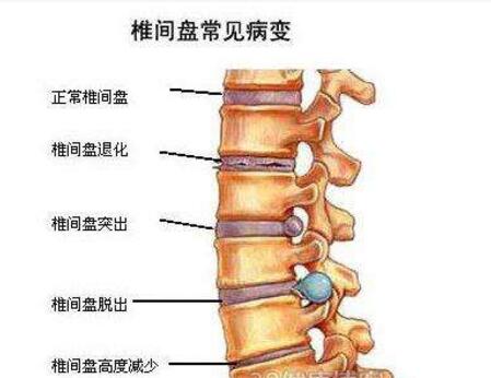 椎间盘膨出怎么办 椎间盘膨出保健方法