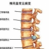 <b>椎间盘膨出怎么办 椎间盘膨出保健方法</b>