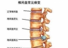 椎间盘膨出怎么办 椎间盘膨出保健方法