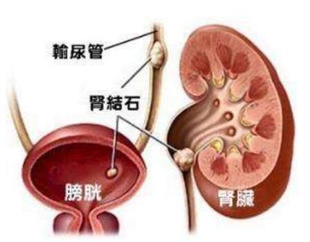 肾结石发病原因 身体变化证明患上肾结石