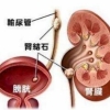 肾结石发病原因 身体变化证明患上肾结石