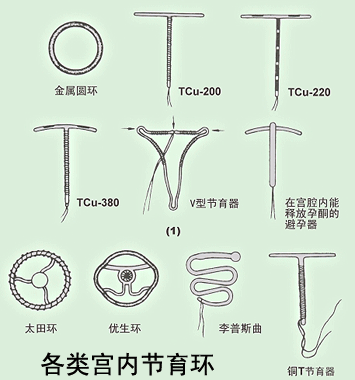 揭秘：女性上环全过程图解