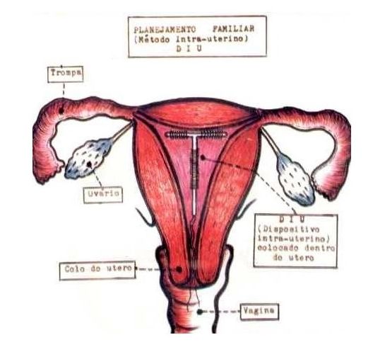 揭秘：女性上环全过程图解