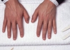 男人肾虚有哪些症状 看指甲上是否有白斑