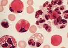 系统性红斑狼疮可以活多久 系统性红斑狼疮有哪些并发症